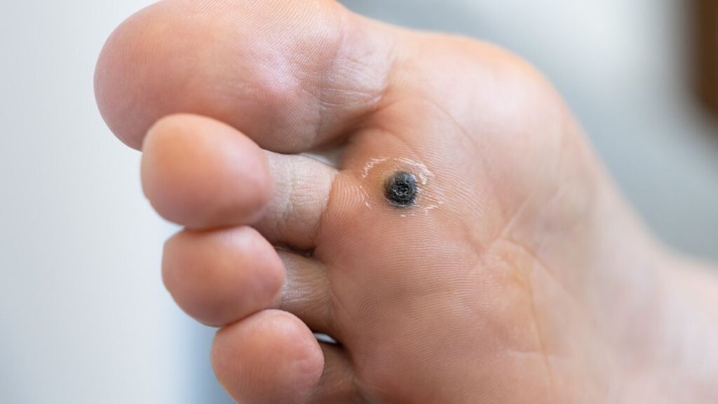 Hongos y verrugas plantares